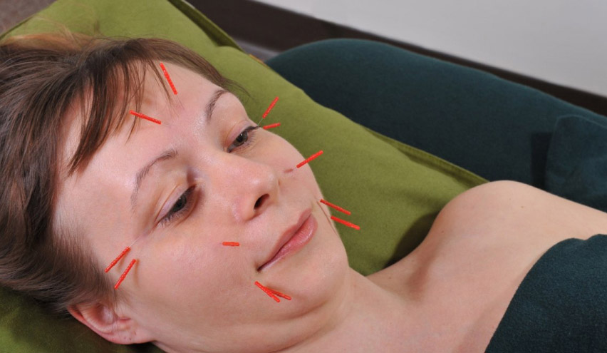 Acupuncture