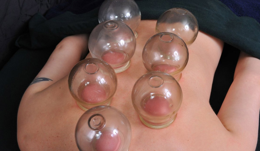 Cupping Therapy